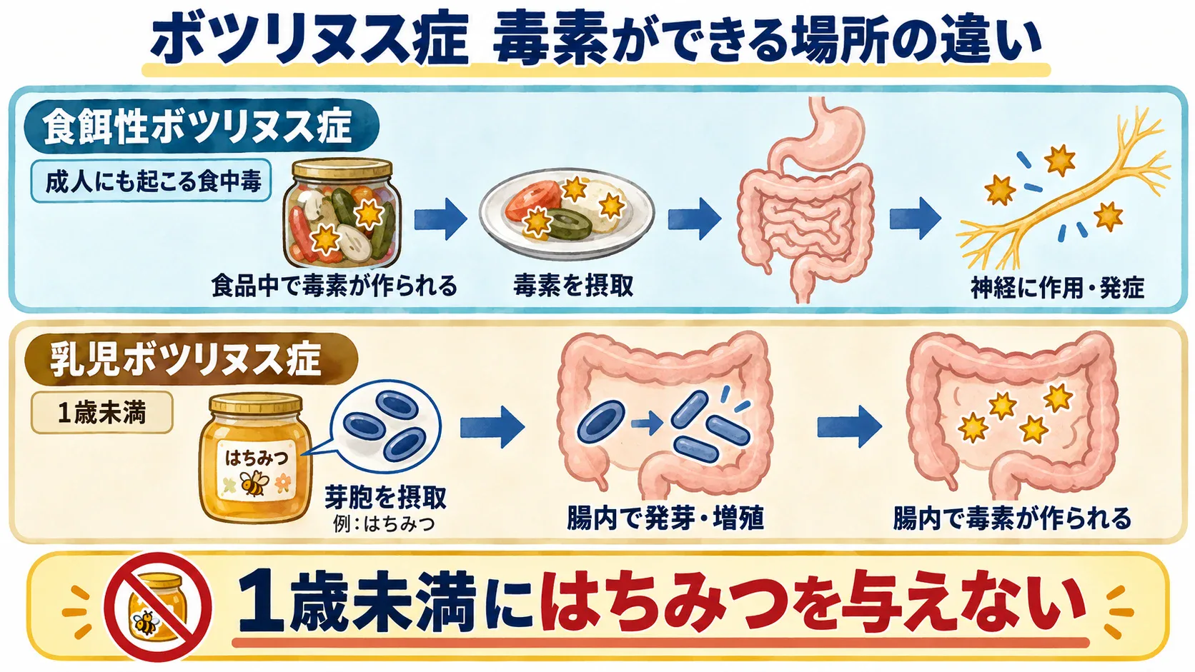 食品中で作られた毒素を摂取する食餌性ボツリヌス症と、摂取した芽胞から腸内で毒素が作られる乳児ボツリヌス症の比較